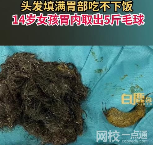 女孩吃头发胃里取出5斤毛球 孩子异食癖很多年头发都快薅没了
