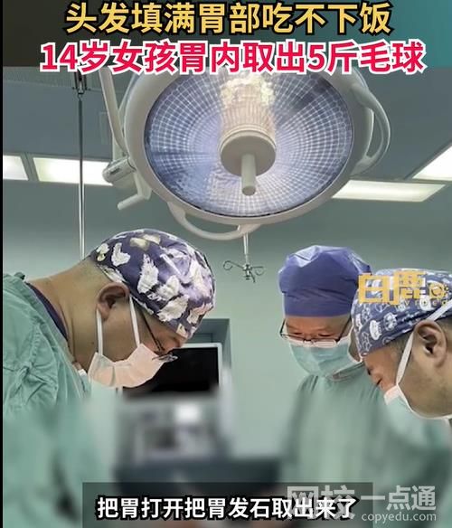 女孩吃头发胃里取出5斤毛球 胃部已被“胃发石”填满