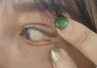 女子称花3万整容 眼球眼角被缝一起 实在太悲剧了
