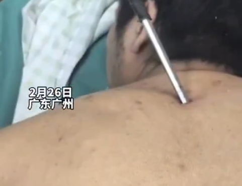 高空掉落30cm螺丝刀直插男子胸腔 简直太吓人了