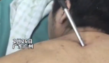 高空掉落30cm螺丝刀直插男子胸腔 简直太吓人了