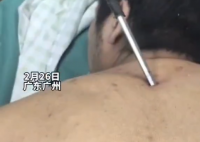 高空掉落30cm螺丝刀直插男子胸腔 简直太吓人了