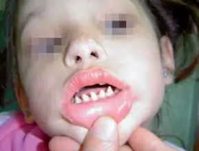 长哪吒同款鲨鱼牙可能患有罕见病 究竟是什么样的？