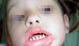 长哪吒同款鲨鱼牙可能患有罕见病 究竟是什么样的？