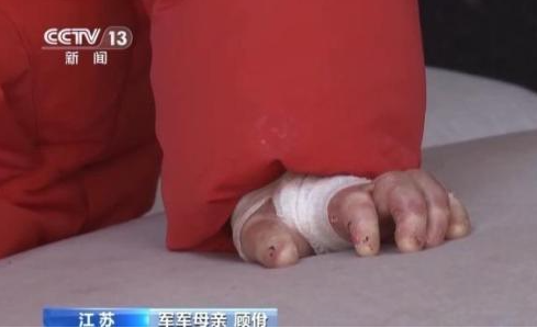 女孩确诊“蝴蝶宝贝”皮肤一碰就碎 这也太罕见了