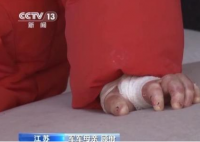 女孩确诊“蝴蝶宝贝”皮肤一碰就碎 这也太罕见了