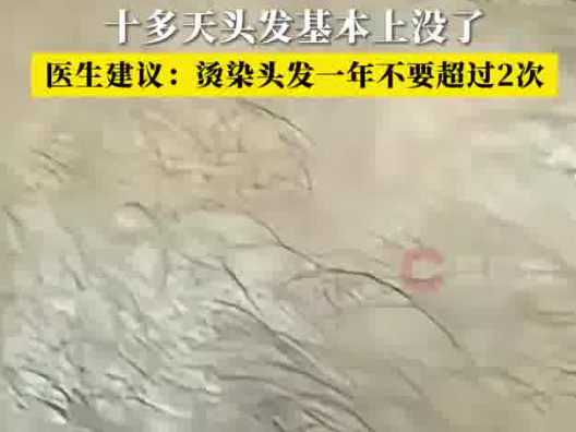 男子一月染头4次致头发大量脱落 实在太无奈了