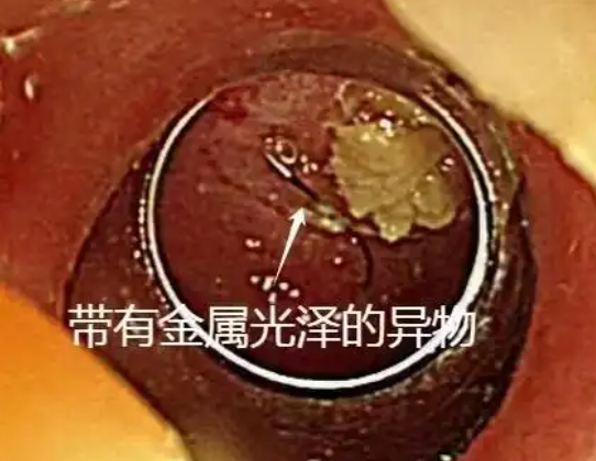 老人突发高烧拍胸片意外发现鱼钩 这也太恐怖了