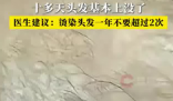 男子一月染头4次致头发大量脱落 实在太无奈了