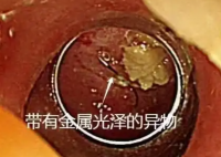 老人突发高烧拍胸片意外发现鱼钩 这也太恐怖了