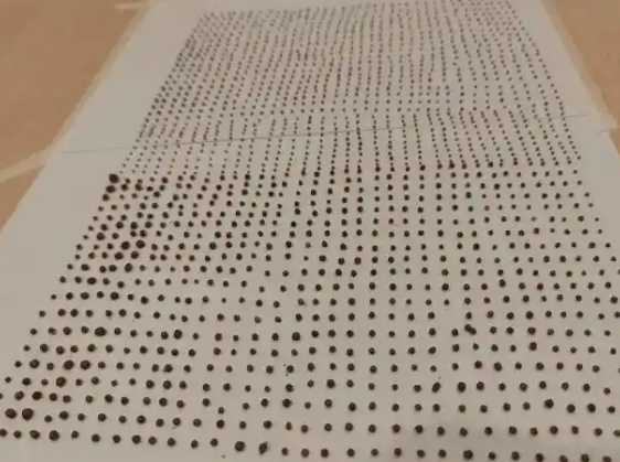 64岁大爷体内取出1791颗结石 这也太恐怖了