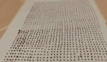 64岁大爷体内取出1791颗结石 这也太恐怖了