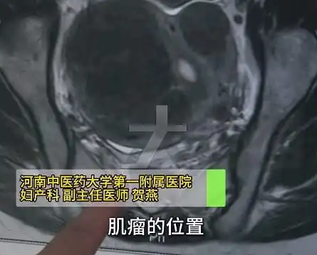 女子爱生闷气子宫里长了8个瘤 实在太恐怖了