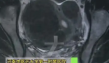女子爱生闷气子宫里长了8个瘤 实在太恐怖了