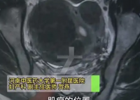 女子爱生闷气子宫里长了8个瘤 实在太恐怖了
