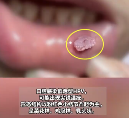 这种口腔溃疡可能是HPV病毒感染 实在太可怕了