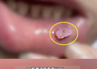 这种口腔溃疡可能是HPV病毒感染 实在太可怕了