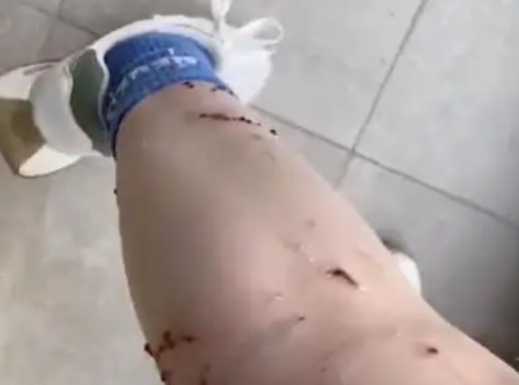 女子被宠物猫咬伤腿部溃烂 究竟是怎么回事？