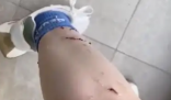 女子被宠物猫咬伤腿部溃烂 究竟是怎么回事？