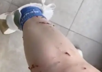 女子被宠物猫咬伤腿部溃烂 究竟是怎么回事？