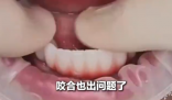 女子花6万植12颗牙2年调试20多次 究竟是怎么回事？