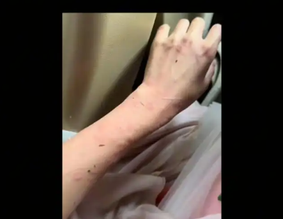 女演员贵州拍戏遇极端天气 胳膊受伤 实在太吓人了