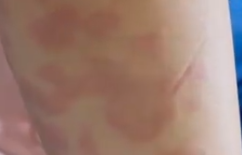 女孩打水光针全身过敏出红斑 究竟是怎么回事？