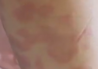 女孩打水光针全身过敏出红斑 究竟是怎么回事？