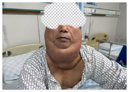 男子每天1斤酒喝出"河马颈" 画面曝光简直不忍直视