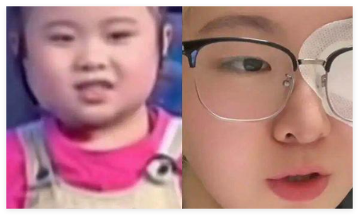 知名童星“秦虹一枝花”右眼失明 到底是什么情况？