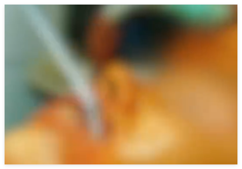 女子注射走私玻尿酸面部感染溃烂 究竟是怎么回事?