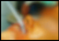 女子注射走私玻尿酸面部感染溃烂 内幕曝光简直太意外了