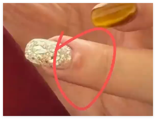 女子做美甲被剪破手指感染HPV 究竟是怎么回事？