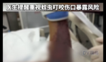 广东阿叔被不明蚊虫咬到险截肢 内幕曝光简直太意外了