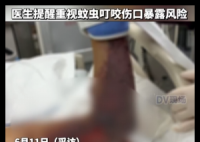 广东阿叔被不明蚊虫咬到险截肢 内幕曝光简直太意外了